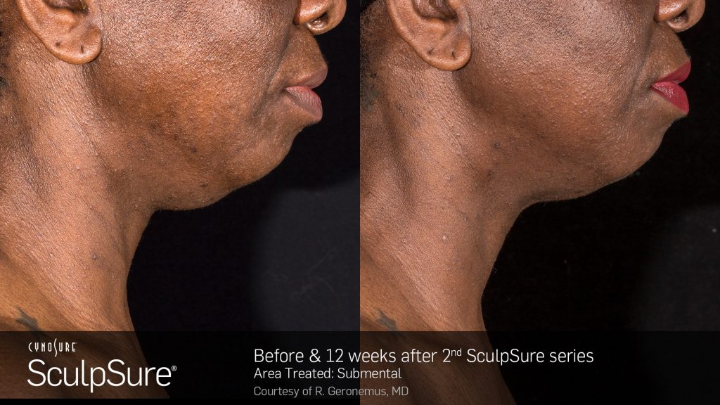 Before and after SculpSure submental results