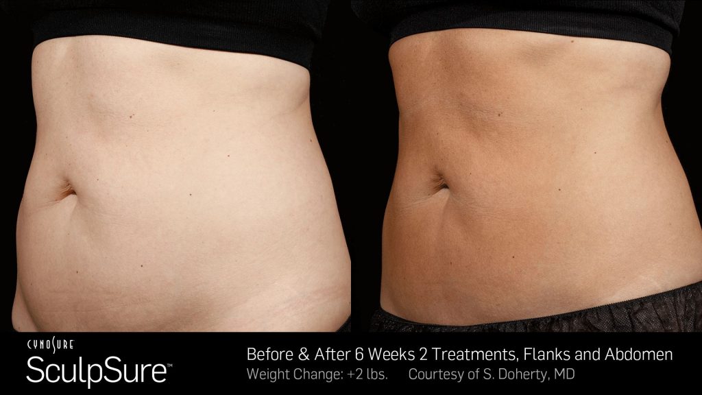 Before and after SculpSure results