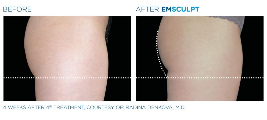 Before and after EMSCULPT butt results