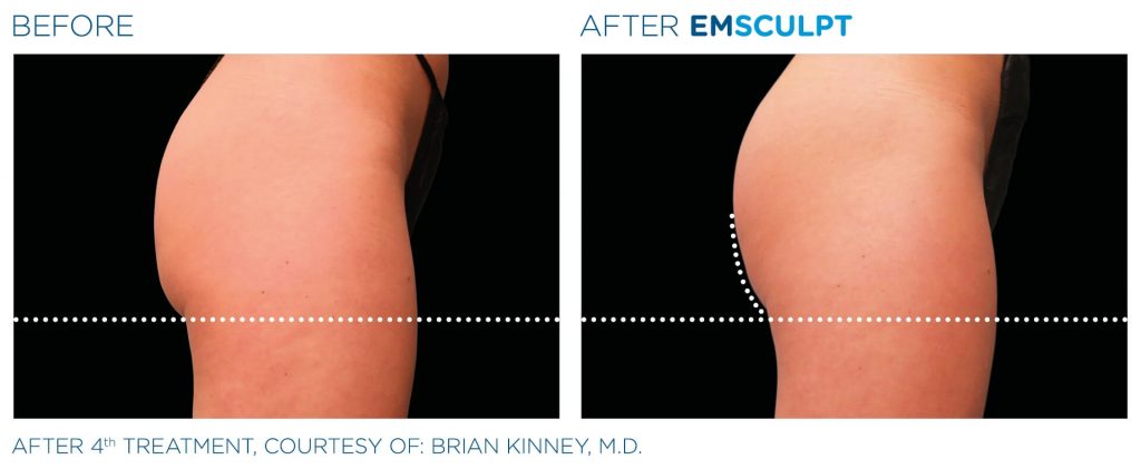 Before and after results