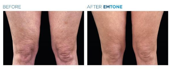 Before and after EMSCULPT results