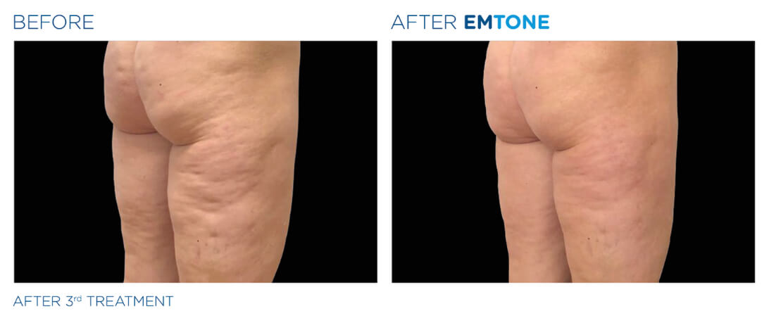 Before and after EMSCULPT results