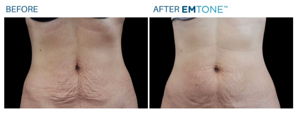 Before and after EMSCULPT results
