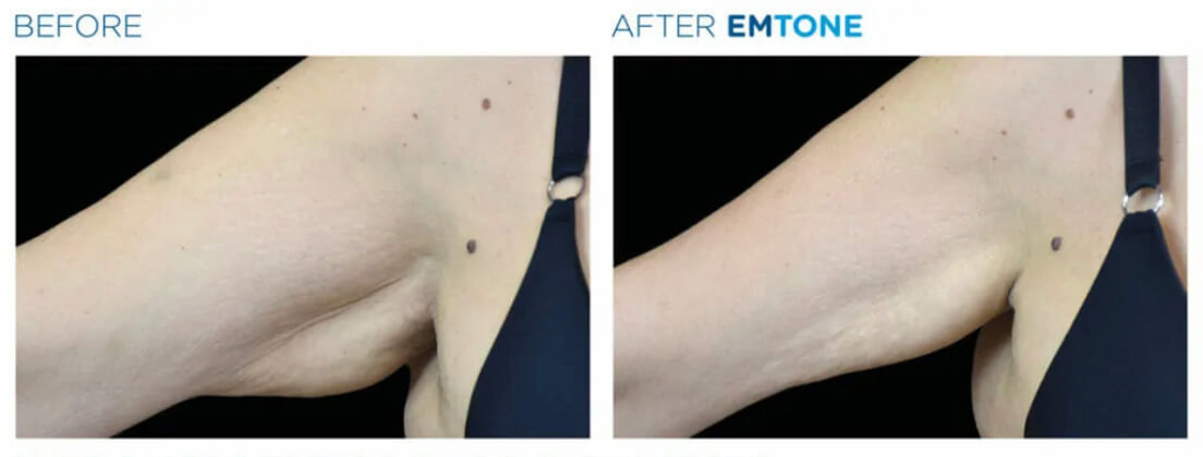 Before and after EMSCULPT results
