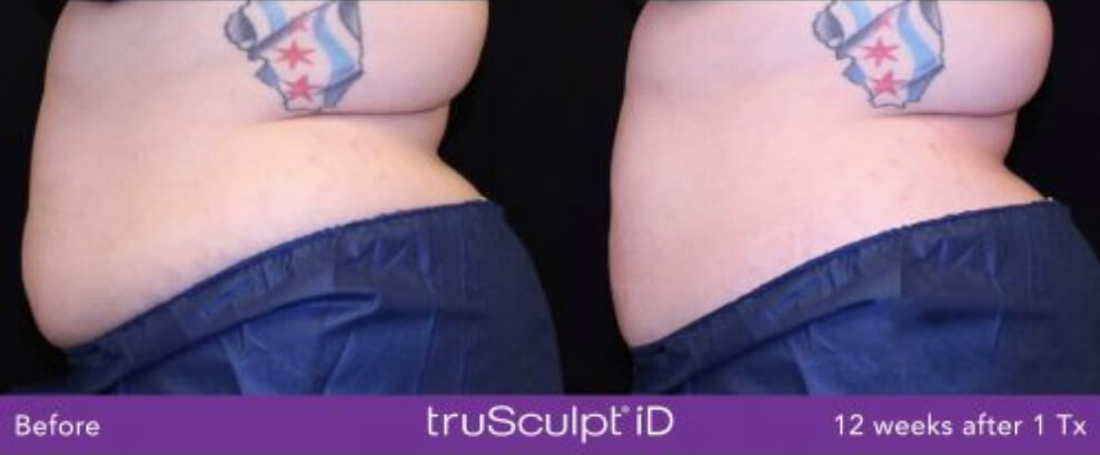 Before and after truSculpt iD results