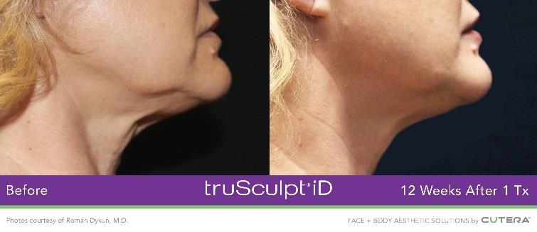 Before and after truSculpt iD results