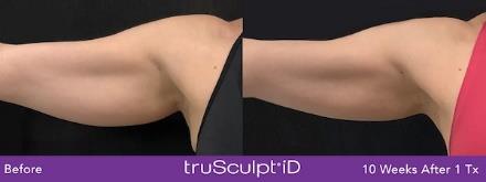 Before and after truSculpt iD results