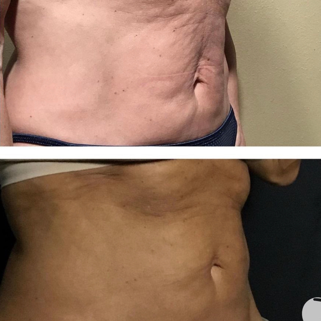 ScarletSRF Textured Skin in stomach Results